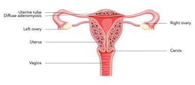 Yazıtlarla Adenomyosis Yayılması, İnsan Anatomisi Kadın Üreme Bozukluğu Sistemi Organları. Latince metinde rahim, rahim ağzı, yumurtalık, fallop tüpü yapısı. Kesik Vektör illüstrasyonunda ön görünüm