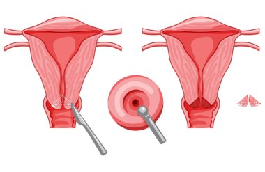 Rahim ağzı kanserinin termal pıhtılaşması kadın üreme sistemi Carcinoma uterus. Ön manzara. İnsan anatomisi iç organları konum şeması, rahim ağzı, fallop tüpü düz stil ikonu