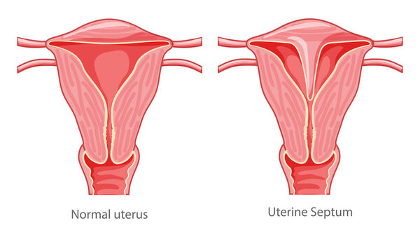 Set of Uterine septum septate uterus Female reproductive system diagram normal and with disease pain. Front view in a cut. Human anatomy internal organs flat icon Vector medical illustration isolated