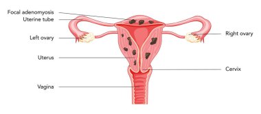 Yazıtlarla Adenomyosis Focal, İnsan Anatomisi Kadın Üreme Bozukluğu Sistem Organları. Latince metinde rahim, rahim ağzı, yumurtalık, fallop tüpü yapısı. Kesik Vektör illüstrasyonunda ön görünüm