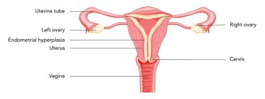 Endometriyal hiperplazya kadın üreme sistemi uterusu farklı stil diyagramlarında bir kesikte yazılı metin Front görünümü. İnsan anatomisi iç organları hastalıklar konum şeması düz biçim simgesi