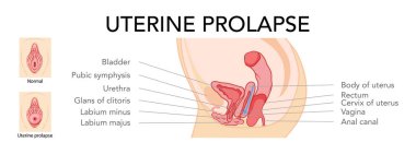Set of uterine prolapse Female reproductive system uterus labeled in Anatomical infographic. Side view in a cut. Human anatomy internal organs location scheme flat icon. Vector medical illustration