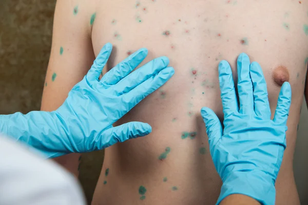Chickenpox. Skin rash. Viral disease. — Stock Photo, Image