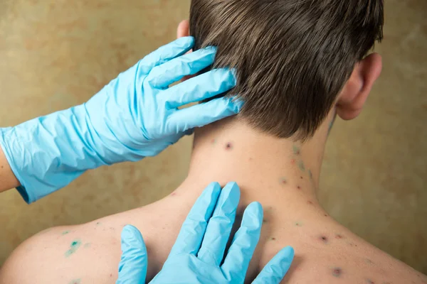 Chickenpox. Skin rash. Viral disease. — Stock Photo © nata-lunataD