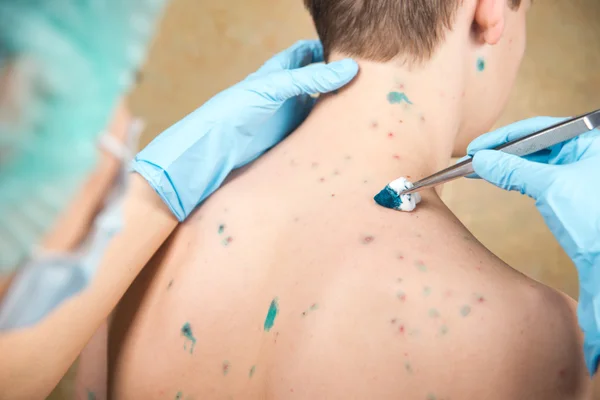 Chickenpox. Skin rash. Viral disease. — Stock Photo, Image