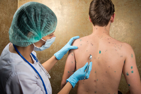 Chickenpox. Skin rash. Viral disease.