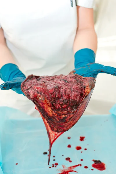 Verloskundige, een arts onderzoekt de gevolgen, de placenta na de geboorte. einde van de derde fase van de arbeid. — Stockfoto