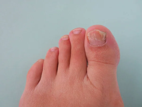 Onicomicosis con infección fúngica en las uñas de los pies sobre fondo claro. Cinco dedos del pie izquierdo de una mujer blanca. El efecto del tratamiento es notable en la miniatura. El rebrote de la uña sana — Foto de Stock