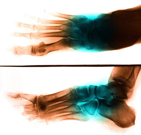 X-Ray scan human for foot — Stock Photo, Image