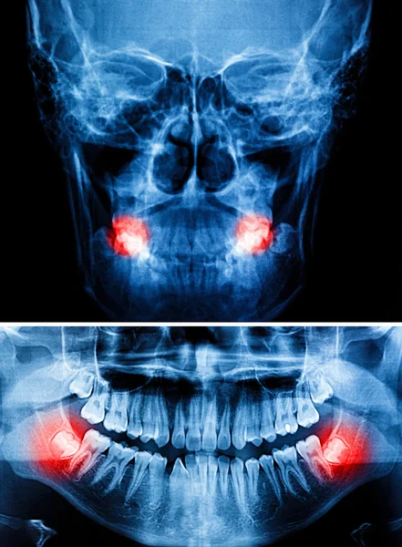 Рентгеновское сканирование человека на зубы — стоковое фото