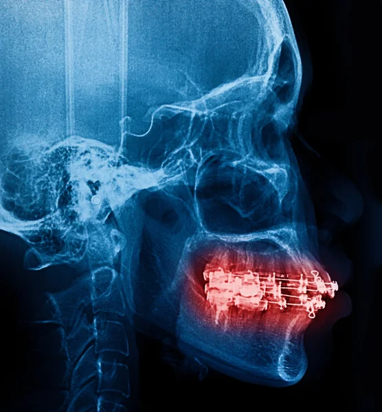 X-ray tarama dişler için insan — Stok fotoğraf