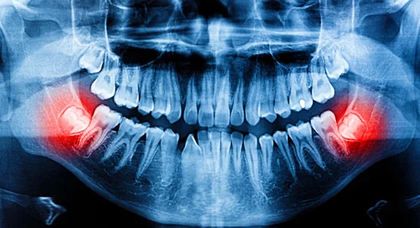 X-ray skanowania ludzkiego do zębów — Zdjęcie stockowe