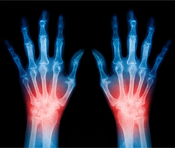 X 射线扫描人类的手 — 图库照片
