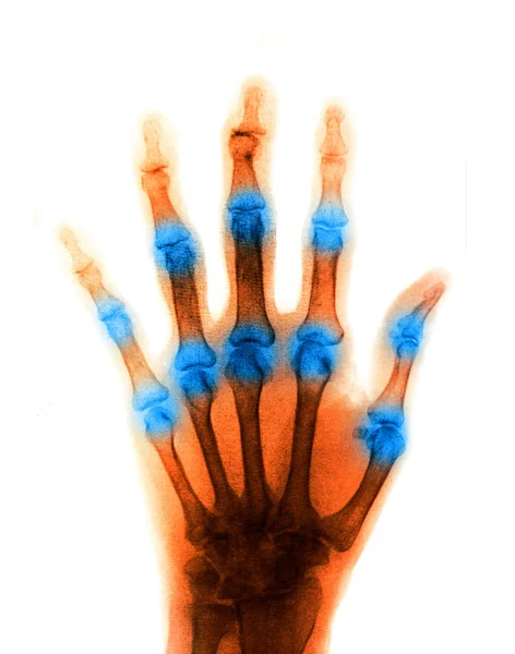 X-Ray scan human for hand — Stock Photo, Image