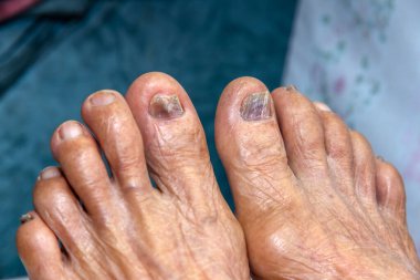  Hastalık belirtilerini kontrol etmek için yaşlı insanın bacağı, sağlık danışma.