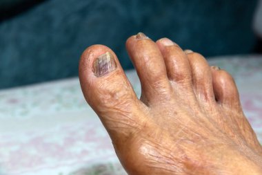  Hastalık belirtilerini kontrol etmek için yaşlı insanın bacağı, sağlık danışma.