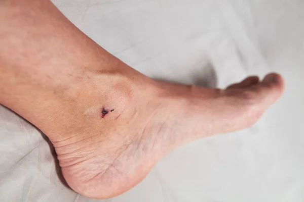 Man\'s ankle with cut skin and scabby wound.