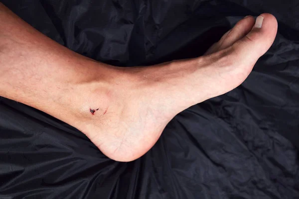 Man\'s ankle with cut skin and scabby wound.
