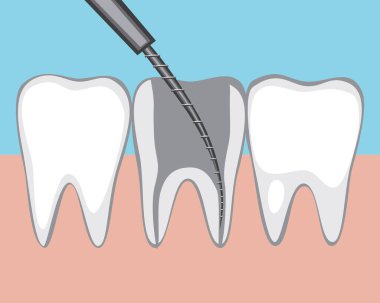 Bir sinirin alınması ya da dişin hamuru. Düz vektör stok çizimi. Pulpititli azı dişi. Sinirli, hastalıklı posalı kanal. Diş etleri bir yetişkinin diş etlerinde. caries tedavisi