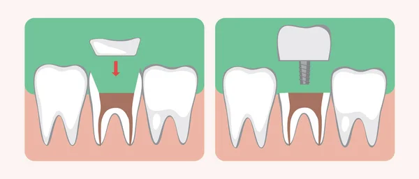 Tipos Micropróteses Implante Dente Ilustração Estoque Vetorial Plano Colagem Conjunto — Vetor de Stock