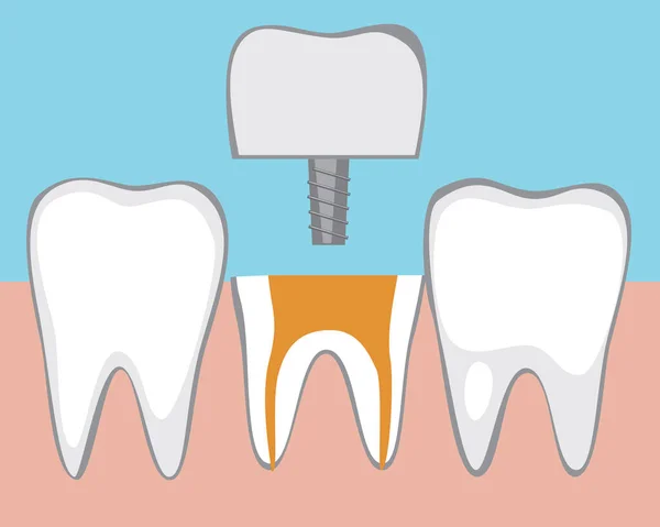 セラミック歯冠 フラットベクトルストックイラスト 運河治療 臼歯の掘削 歯の矯正 深い関心事だ 健康な歯 — ストックベクタ