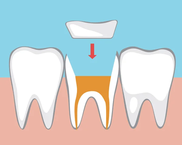 Micropróteses Dente Ilustração Estoque Vetorial Plano Tratamento Canal Despolpação Molar — Vetor de Stock