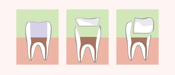 Restauração Dente Com Recheio Embutimento Cerâmico Onlay Ilustração Estoque Vetorial — Vetor de Stock