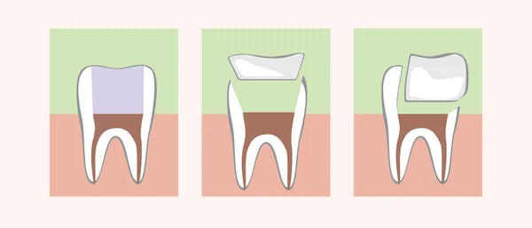 Restoration Tooth Filling Ceramic Inlay Onlay Flat Vector Stock Illustration — Stock Vector