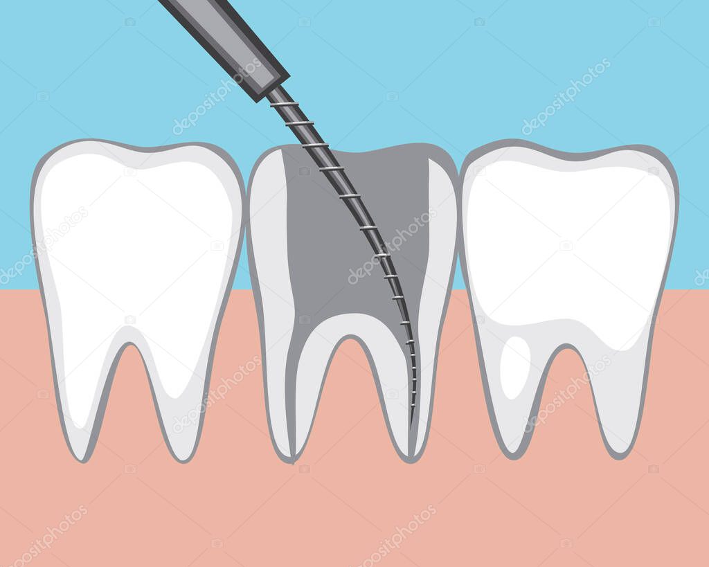 Removal of a nerve or pulp in a tooth. Flat vector stock illustration. Molar with pulpitis. Diseased pulp canal with nerve. Teeth on the gums of an adult. caries treatment