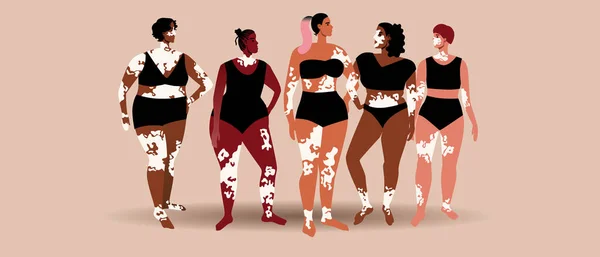 Vitiligo 'su olan, deri dökülmesi olan insanlar. Düz vektör stok çizimi. Melanin hastalığı ve vücut pozitifliği. Farklı görünüm kavramı