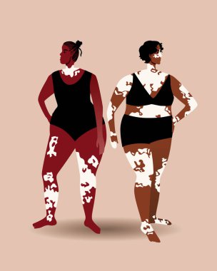 Vitiligo ve kilolu kadınlar. Düz vektör stok çizimi. İnsanlarda koyu ten. Hastalıktan dolayı depegmentasyon. Deride leke var. İkisi tasarım için izole edilmiş.