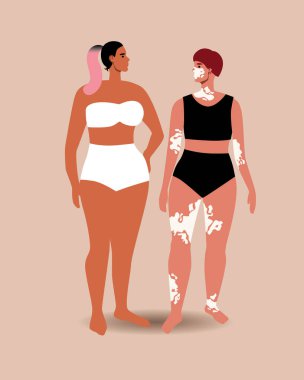 Farklı kadınlar, vitiligo 'su olan insanlar. Düz vektör stok çizimi. İnsanların güzel doğal görünüşü, farklı bir vücut yapısı. Deri dökülmesi, vitiligo hastalığı. İkisi tasarım için izole edilmiş.
