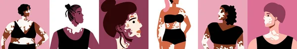 Schoonheid Van Vrouwen Met Vitiligo Verscheidenheid Van Uiterlijk Platte Vectorvoorraadillustratie — Stockvector