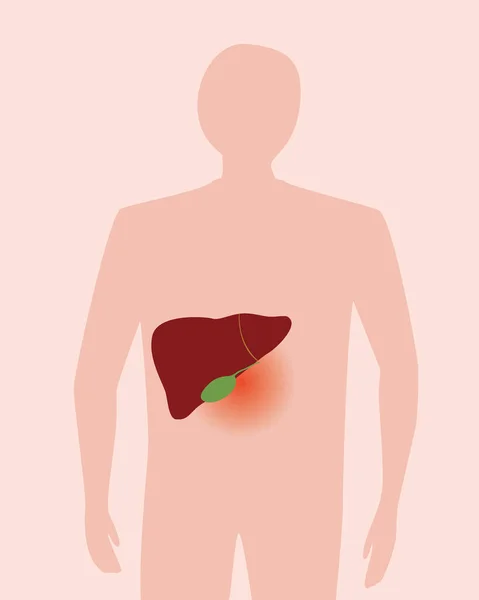 Dor Órgão Humano Fígado Ilustração Estoque Vetorial Plano Homem Abstrato —  Vetores de Stock