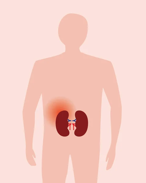 Dolor Órgano Renal Humano Ilustración Vector Plano Hombre Abstracto Como — Archivo Imágenes Vectoriales