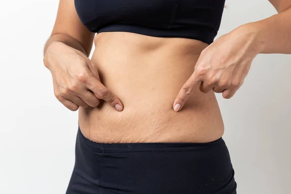 Stretch Marks Kvinnor Visa Upp Magen Efter Födseln Vit Bakgrund — Stockfoto