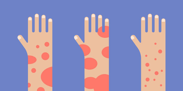 Hand with psoriasis wounds. People suffering from psoriasis banner vector illustration.