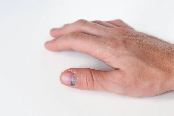 Una Mano Con Dedo Herido Sobre Fondo Claro Miniatura Azul Fotos de stock