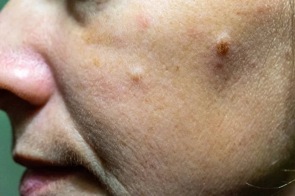 Close Woman Cheek Problem Skin — Stockfoto