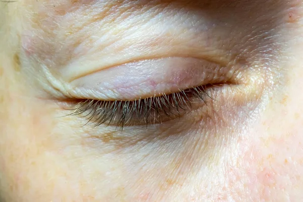 Woman Closed Eye Close Problematic Skin Eye — Stockfoto