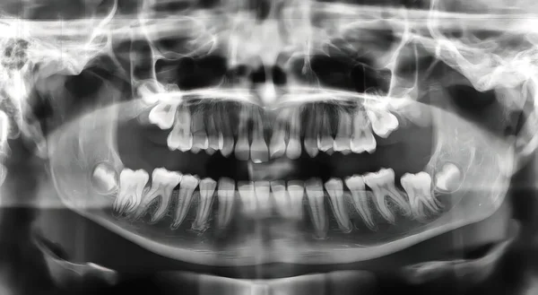 Panoramic radiography (orthopantomography) by means of X-rays showing the dental structure and oral anatomy of a twelve-year-old girl to analyze any oral complications in the field of dentistry