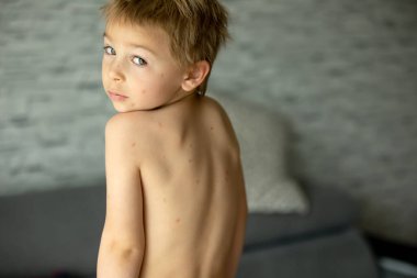 Küçük çocuk, su çiçeği hastası çocuk, hafif kızarıklık, hastalığın ilk aşaması.