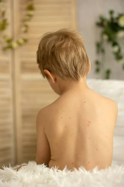 Toddler Boy Chicken Pox Lying Bed Fever Mother Checking Him — Stok fotoğraf