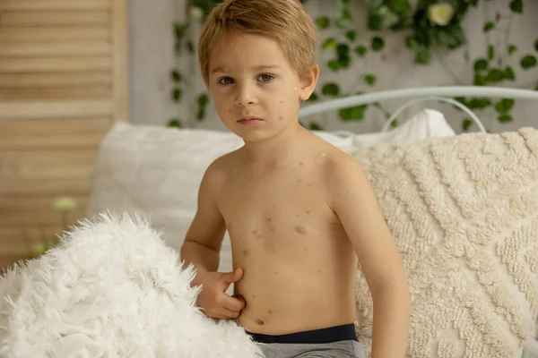 Toddler Boy Chicken Pox Lying Bed Fever Mother Checking Him — стоковое фото
