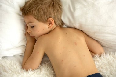 Su çiçeği olan çocuk, ateşler içinde yatarken, annesi endişeyle onu kontrol ediyor.