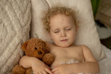 Su çiçeği hastası küçük bir kız, evde oynuyor, hastalık sırasında karantina altında, Varicella zoster virüsü ya da suçiçeği kabarcığı kızarıklığı.