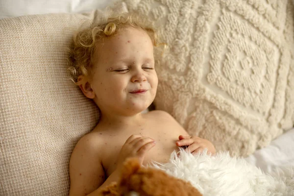 Menina Pequena Com Varicela Cama Brincando Casa Isolamento Quarentena Durante — Fotografia de Stock