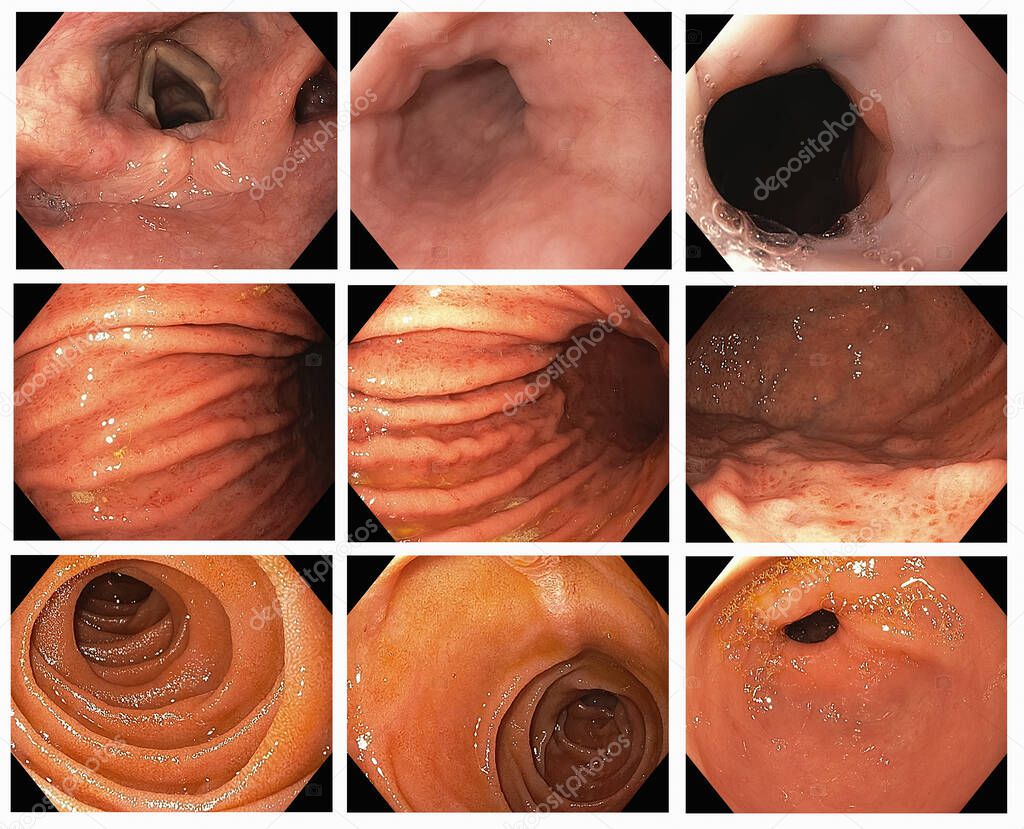 Gastrointestinal endoscopic image of Esophagogastroduodenoscopy with infectedand finding diffusion of erythematous mucosa with petechiae and H.pylori infected