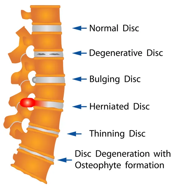 Condições da coluna vertebral — Vetor de Stock