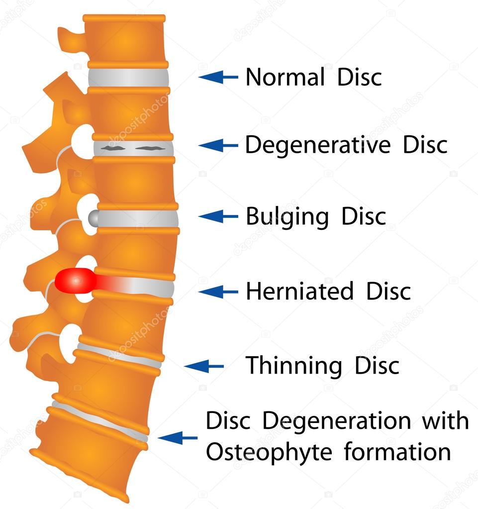 Spine conditions